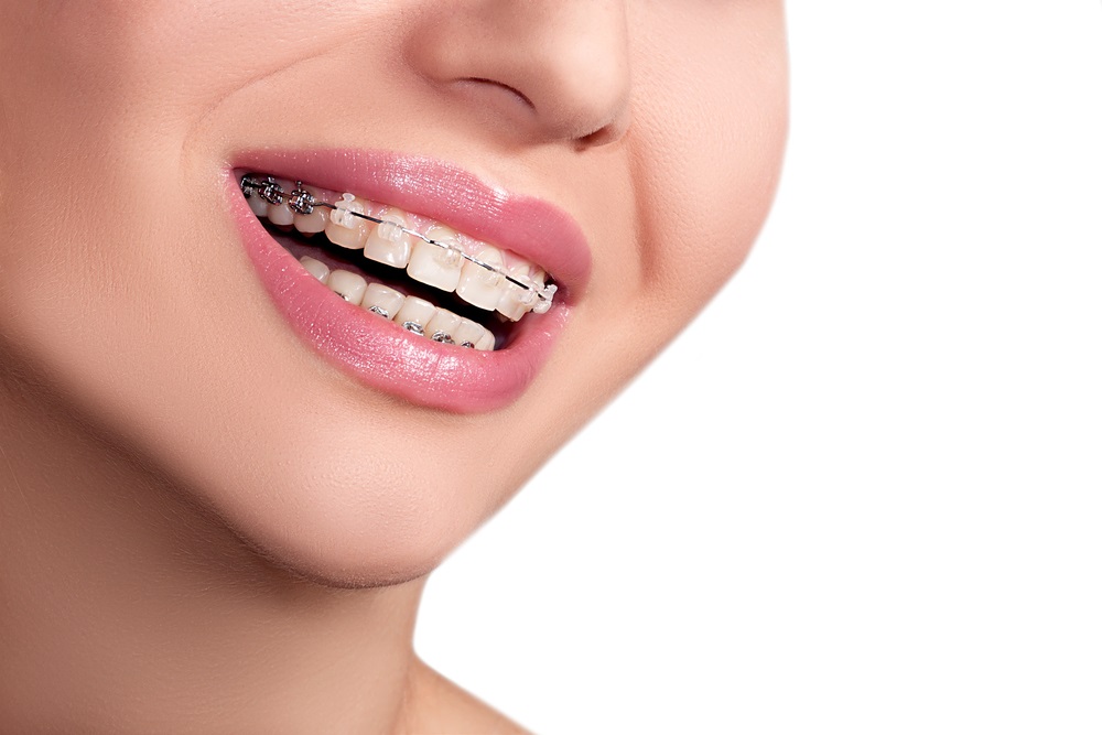 Close-up of woman smiling with ceramic (clear) braces