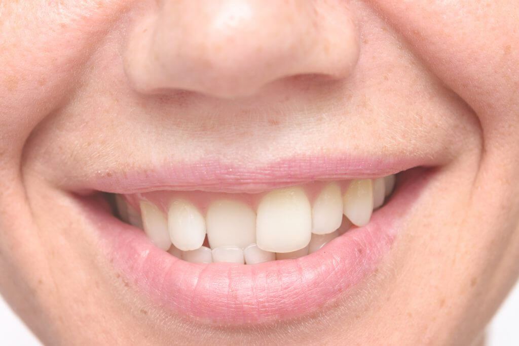 Cách khắc phục răng không đều màu