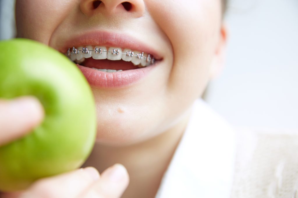 Cropped photo of young woman in dental braces want to eat fresh green apple.