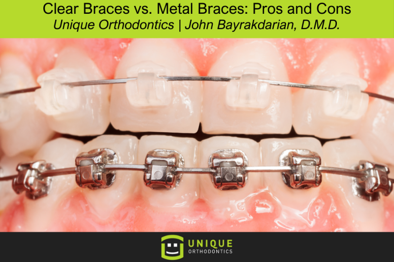 Clear Braces vs. Metal Braces: Pros and Cons