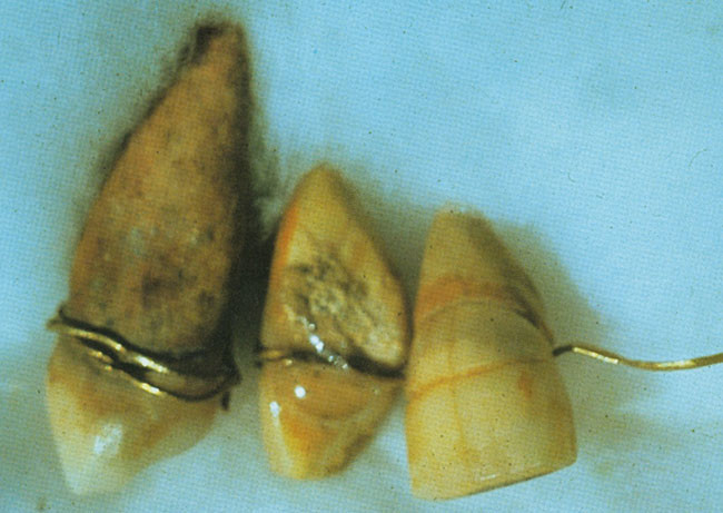 Image of an Egyptian mummy's teeth being bonded by metal bands as a form of braces