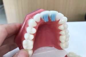 3D model of a perfect smile with two, blue bite turbos on the back of the front teeth