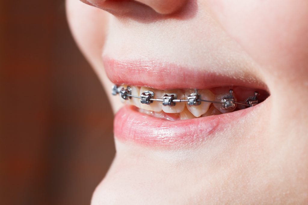 Close-up of a smile with Damon Braces on the teeth