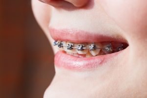 Close-up of a smile with Damon Braces on the teeth