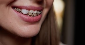 Woman smiling with orthodontic wax on her brackets of her braces