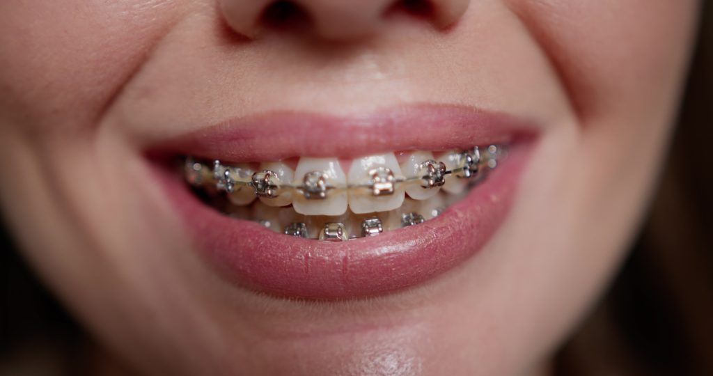 Close-up of a woman smiling big with her braces