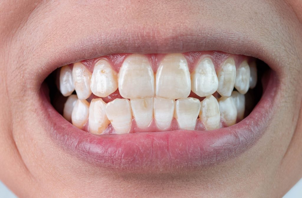 Close-up of a smile with white spots on the teeth