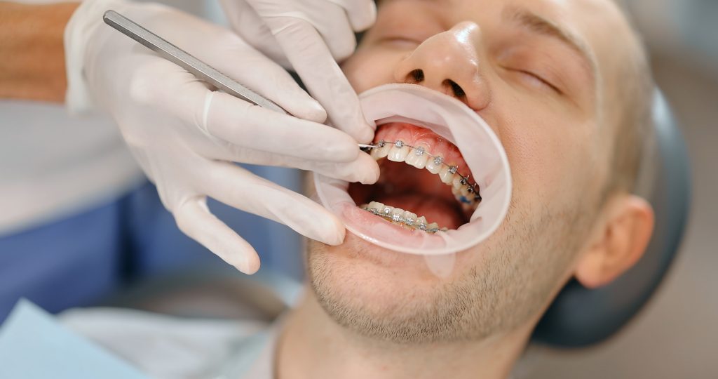 Young male patient with dental braces during a regular orthodontic visit. Dentist adjusting orthodontic brackets, close-up on patient's mouth.