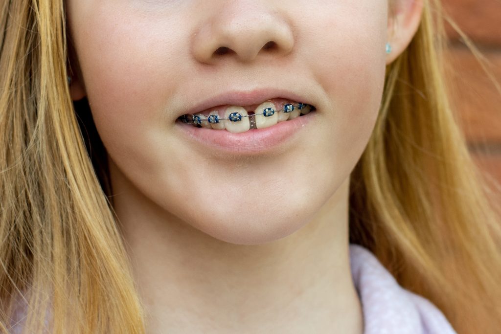 Close up of a teenage girl wearing metal braces. Orthodontic dental braces teeth straighteners. Bracket system. A gap between front teeth