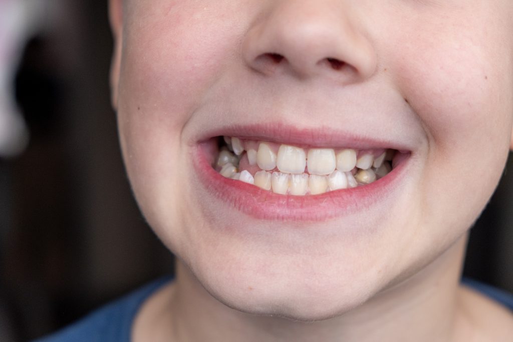 Child's crooked teeth. Young man showing crooked growing teeth. The child needs to go to the dentist to install braces.