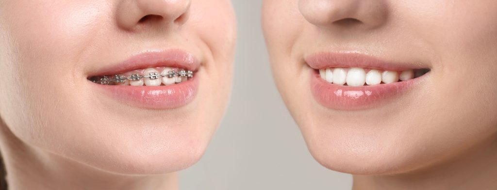 Woman showing teeth while and after using dental braces, closeup. Collage with photos on grey background