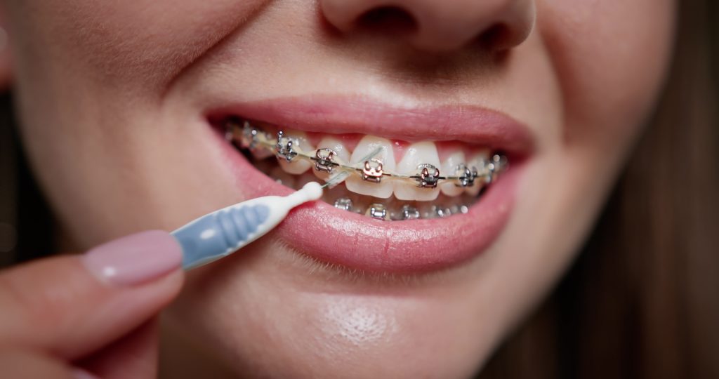 Close-up of woman cleaning dental braces with specialized brush. Oral hygiene and orthodontic care concept captured vividly, demonstrating meticulous dental care routine. Dental Braces.