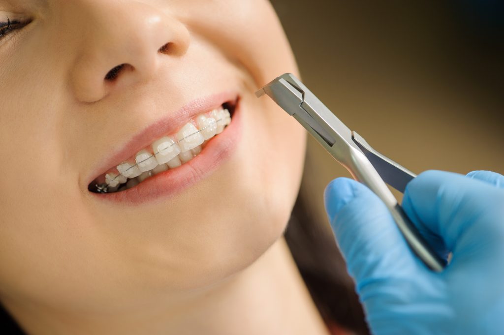 Close-up smiling woman with ceramic braces on teeth at the dental office. Dentist holding dental tool - corner ligature cutters. Orthodontic Treatment