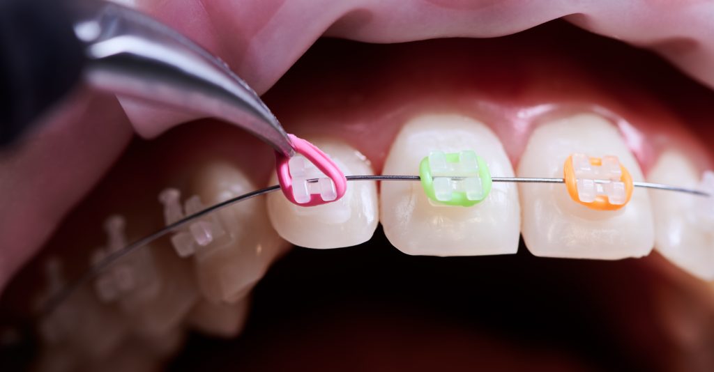 Close up of doctor installing colorful elastic rubber bands to patient brackets. Person with wired braces on teeth having dental procedure in clinic.
