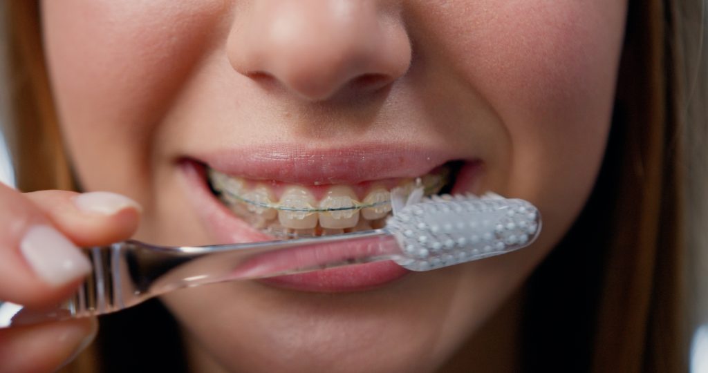 Close Up. Oral hygiene for braces. Teen girl cleaning and brushing teeth with clear ceramic braces using special brushing tools.